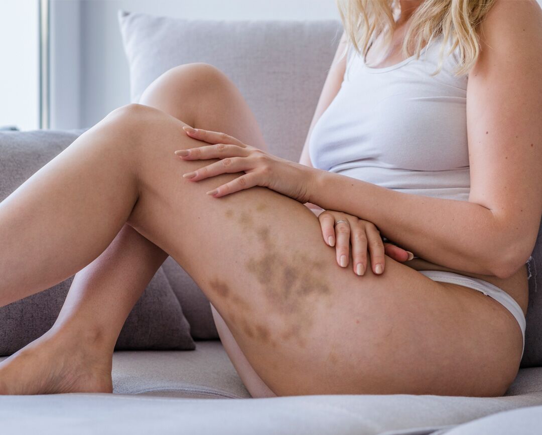 Skincare Exams Bruise Thigh