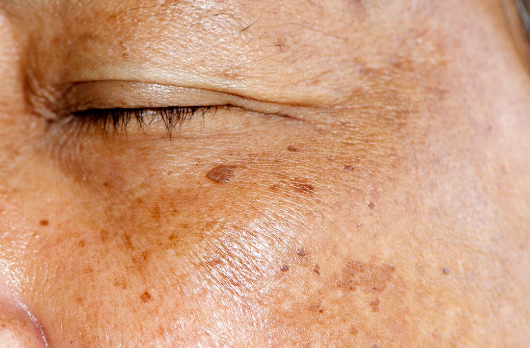 Skincare Exams Hyperpigmentation