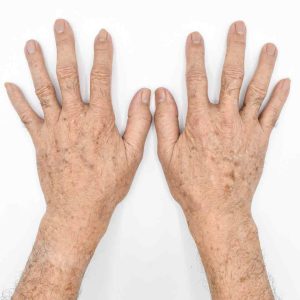 lentigines - lentigo